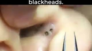 Blackhead in ear removal [upl. by Pomfrey]