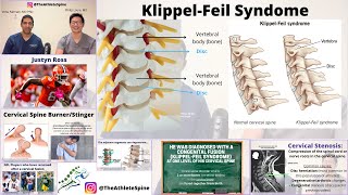 Cervical Stenosis and Congenital Fusion KlippelFeil in NFL Wide Receiver Justyn Ross [upl. by Sapowith]