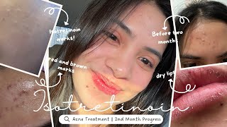 Accutane Journey  Two Months Progress Road to Clear Skin [upl. by Aryl345]