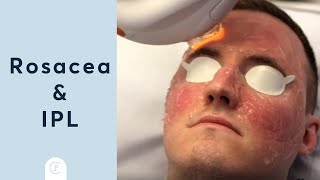 Rosacea Treatment at Pulse Light Clinic London [upl. by Zorana]