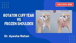 Rotator Cuff tear VS Frozen Shoulder Dr Ayesha Rehan [upl. by Cerveny]