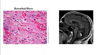 USMLE ACE Video 200 Classification and Pathophysiology of Common Adult and Pediatric Brain Tumors [upl. by Herates]