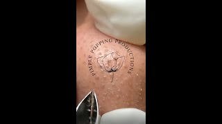 Satisfying nose pimple removal [upl. by Miharba]