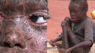 Kenyan Children Suffer from Skin Disease with no cure [upl. by Niaz]