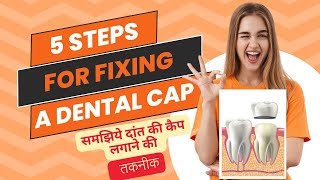 दांतो पर कैप लगाने की तकनीक DENTAL CAP LAGANE KI TAKNEEK Tooth cap fixing procedure in steps [upl. by Mordy213]