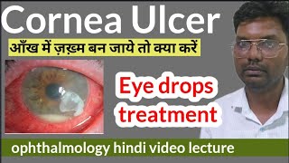 cornea ulcer treatment  cornea foreign body  corneal ulcer treatment  cornea ulcer eye drops [upl. by Lyns208]