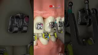 ¡TUTORIAL de como instalar BRACKETS metálicos en los DIENTES FRENILLOSBRACES [upl. by Jewell]