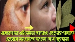 মাএ ১ দিনে মেছতার দাগ দূর করার উপায়তেজপাতা দিয়ে মেছতার দাগ চিরতরে দূরমেছতামুখের কালো দাগ দূর [upl. by Jemie]