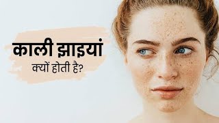 चेहरे की झाई  remove pigmentation  remedy of melasma  elocon cream  Freckles face  Jhaiya [upl. by Consolata309]