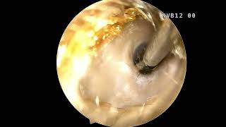 Endoscopic Ear Cleaning [upl. by Nottus]