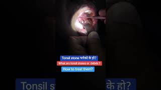 Tonsil stones  Tonsillolith  dr krishna koirala pokhara [upl. by Salocin]