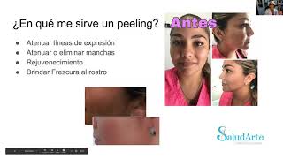 Peeling con Laser Fotona [upl. by Marienthal]