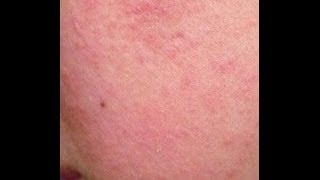 Faire disparaître les cicatrices dacné Remove scars acne [upl. by Wayolle]