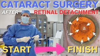 Cataract Surgery after Retinal Detachment  3 Min Polishing  Full Video from Start to Finish [upl. by Onitnerolf]