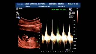 Ultrassom  Translucência Nucal  11 semanas [upl. by Htyderem]