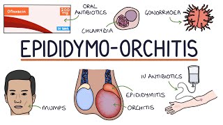 Understanding Epididymoorchitis [upl. by Islehc432]