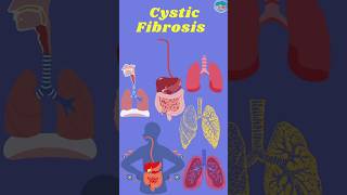 Cystic Fibrosis Mechanism Development Management and Treatment cysticfibrosis cystic [upl. by Asnarepse]