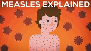 Measles Explained — Vaccinate or Not [upl. by Aliuqehs]