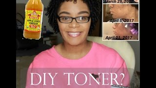 DIY Apple Cider Vinegar Toner for Acne amp Oily Skin Before amp After Pictures [upl. by Yecniuq]