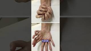 Mirror Hand Syndrome A Rare Condition short facts [upl. by Affer]