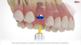 On1 restorative concept  Nobel Biocare [upl. by Selima]