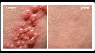 How To Cure Herpes  Cures for Herpes  Herpes Cures [upl. by Germayne]