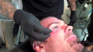 Rich Piana getting dermal implant removed [upl. by Trah]