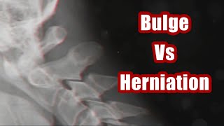 Bulging Vs Herniated Discs and When To See A Doctor [upl. by Liesa354]