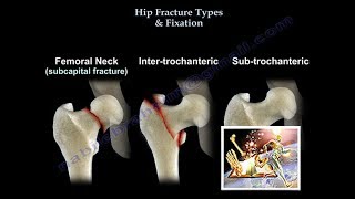 Hip Fracture Types amp Fixation  Everything You Need To Know  Dr Nabil Ebraheim [upl. by Darrel]