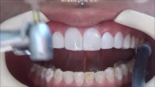 Veneers Polishing Step by Step all the secrets [upl. by Mosnar778]