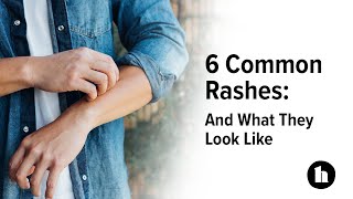 6 Common Rashes And What They Look Like  Healthline [upl. by Fifi]