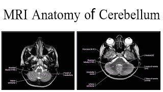 MRI Anatomy of cerebellum [upl. by Lempres]