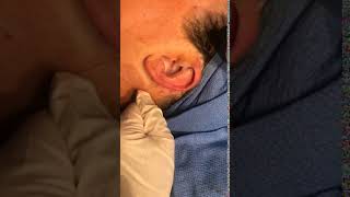 Otoplasty Surgical Technique by Dr Tina [upl. by Haimerej835]