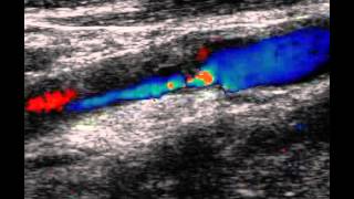 INTERNAL CAROTID ARTERY HEMODYNAMIC HETEROGENEOUS PLAQUE [upl. by Weissmann294]