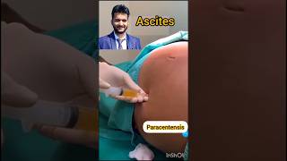 Ascites paracentesis shorts medical nursing alcohol side effects [upl. by Eronel]