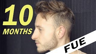 FUE Hair Transplant 10 Months post op Istanbul Turkey [upl. by Debby682]