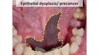 Pathogenesis of Oral Cancer [upl. by Lugo705]