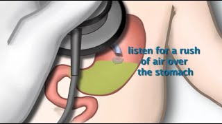 Nasogastric Tube Placement by S Hamilton  OPENPediatrics [upl. by Bertie413]