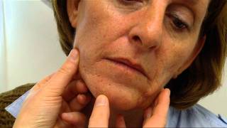 Acne littekens behandelen met fractional CO2 laserwmv [upl. by Garrison888]