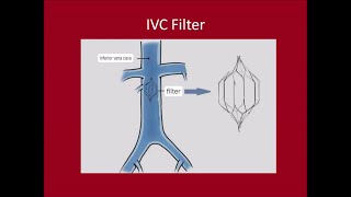 Management of DVTPulmonary Embolus [upl. by Charleton885]