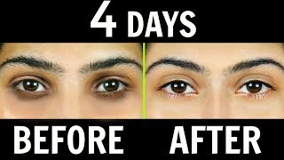 How to Remove Dark Circles Naturally in 4 Days 100 Results  Anaysa [upl. by Linkoski407]