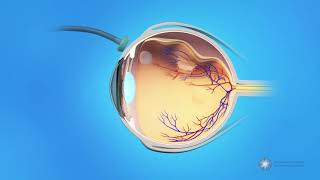 Vitrectomy Surgery for Detached Retina [upl. by Helsell130]