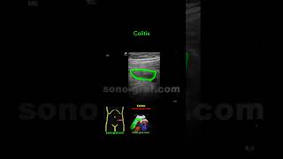 Sonography  Diverticulitis [upl. by Belamy]