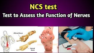 NCS Test  Nerve Conduction Study Procedure [upl. by Lobel]