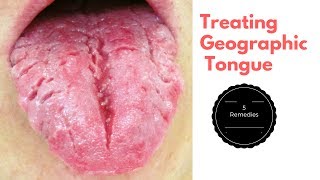 Top 5 Home Remedies for Treating Geographic Tongue [upl. by Barsky]