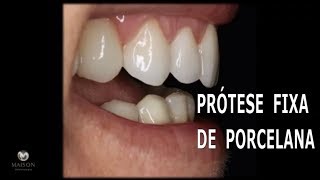 Prótese fixa de Porcelana com Implantes [upl. by Nabe]