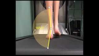 Over Pronation and how this is measured in walking [upl. by Jobyna133]