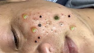 Blackheads amp Milia Big cystic acne blackheads extraction whiteheads Removal Pimple Popping 2 Cop [upl. by Starkey]