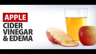 Apple Cider Vinegar for Edema [upl. by Adnarrim715]