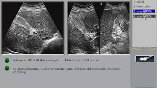 Liver Ultrasound Viral hepatitis in Arabic الالتهاب الكبدي الفيروسي [upl. by Pesek]